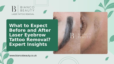 What to Expect Before and After Laser Eyebrow Tattoo Removal? Expert Insights